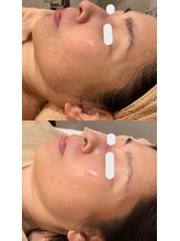 ハピエスト 田辺店/水光ピール