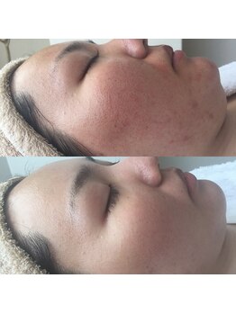 ナヴィータ アオバダイ(Navita AOBADAI)/エンビロン/2ヶ月集中コース