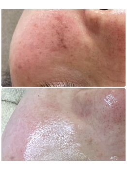 プリエ(Prier)/シミケアも◇ハーブピーリング◇