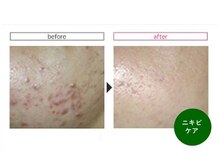 ベルメイク(BELLE MAKE)/シルク肌ハーブピーリング☆