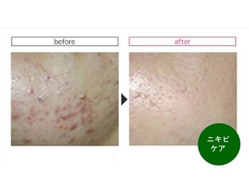 ベルメイク(BELLE MAKE)/シルク肌ハーブピーリング☆