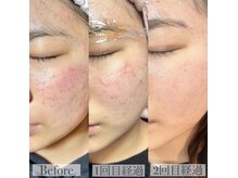 ワンミュ(One.miu)/韓国式ハーブピーリング 