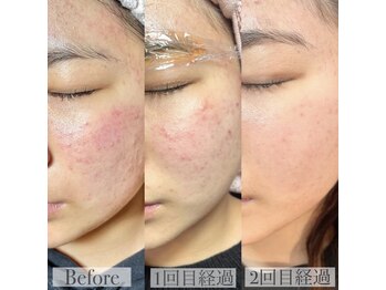 ワンミュ(One.miu)/韓国式ハーブピーリング