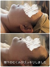 ブルーローズ(BlueRose)/ラジオ波/痩身/リンパマッサージ