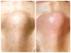 ジーンバイピエル 中野店(gene by PIEL)の写真/【いちご鼻卒業!】話題の毛穴エクストラクションで毛穴のお悩み改善◎毛穴がクリアになり肌トーンUP![中野]
