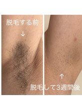 サロンアンドビューティ エス チャタン(Salon＆Beauty S chatan)/【メンズ】ワキ脱毛