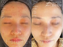 ベル 札幌(Belle)/ハーブピーリング｜毛穴ケア