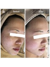 モカ 天王寺店(MOKA)/剥けない　ハーブピーリング 艶