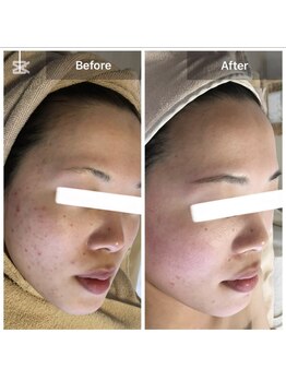 モカ 天王寺店(MOKA)/剥けない　ハーブピーリング 艶