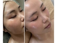 ビオン 松戸(bion)/フェイシャルbefore→after