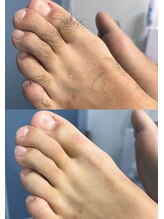 シルビー(CILBE)/足ミックス脱毛