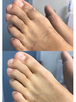 シルビー(CILBE)/足ミックス脱毛