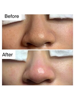 癒える(ielu)/毛穴エクストラクションB/A