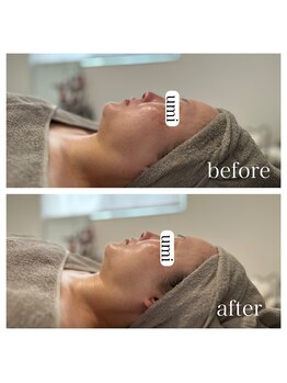 ウミ(umi)/一度の施術で☆