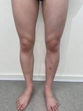 ロイビー(loeyB)/脱毛１目回から1ヶ月後