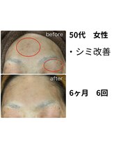 ビープラス(Biplus)/【50代お悩み】シミ改善　