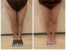 インディバジェム(GEM)/ビフォーアフター