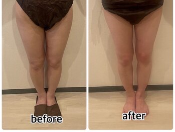 インディバジェム(GEM)/ビフォーアフター