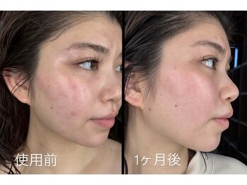 ラムーン(La.Moon)/週1美容鍼×ホームケア