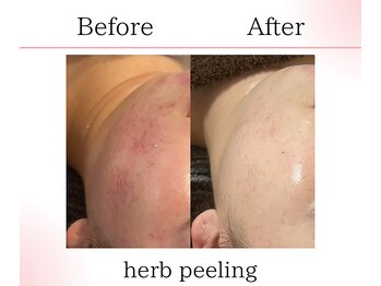 サロンツキ(salon tuki)/ハーブピーリング症例/徳島