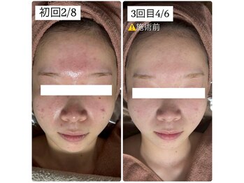 アルムダアクア 天王寺店(Aleumda AQUA)/ハーブピーリング/大阪/天王寺