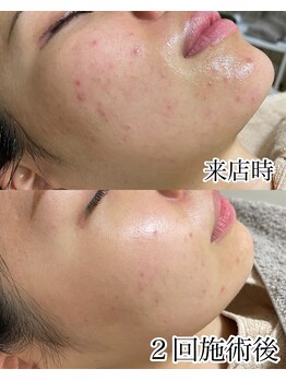 ハル(Halu)/2回ハードハーブピーリング施術