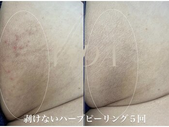 ヴィーダ 渋谷松濤(ViDA)/REVIお尻ハーブピーリング