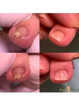 巻き爪補正店 越谷店/巻き爪ケア