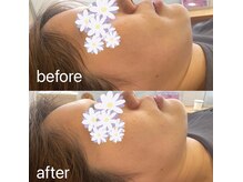 ピエール ナリタイラボ 薬院店(Piel NARITAI LABO)/小顔矯正ですっきり♪