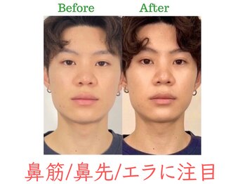 ラプリ 福岡博多店(Raplit)/隆鼻+輪郭・小顔矯正 美鼻/小顔