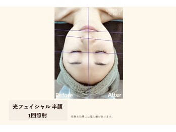 サロン ルアナ(salon luana)/リフトアップ、ハリ、ツ効果☆