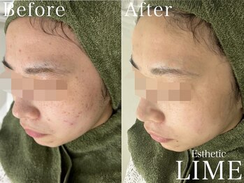 ライム 天神(LIME)/before&after　頬のニキビケア