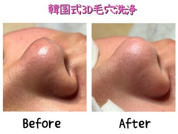 ダイヤモンド リーエンダ(Diamond leende)/韓国式3D毛穴洗浄