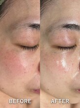サロンドジェシカ(salon de Jessica)/ハーブピーリング
