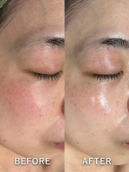 サロンドジェシカ(salon de Jessica)/ハーブピーリング