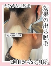 サロンシャイン(Salon Shine)/うなじ脱毛