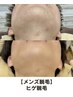 【メンズ脱毛】ヒゲ脱毛初回体験¥3,000
