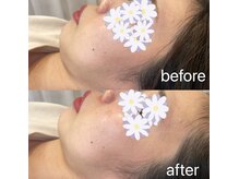 ピエール ナリタイラボ 薬院店(Piel NARITAI LABO)/フェイスラインがくっきりと♪