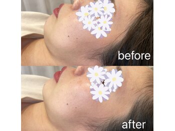 ピエール ナリタイラボ 薬院店(Piel NARITAI LABO)/フェイスラインがくっきりと♪