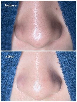 サロン ド ラム/［毛穴改善コース］3回目の効果