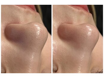 エヌエースキン センター北店(NA skin)/ハーブピーリング｜毛穴洗浄