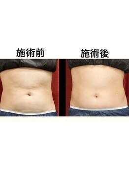 椎名亮 整体院/メディセルの施術例・セル取り