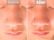 ボーンオム(Born Homme)/毛穴洗浄＋美容液導入：20代男性