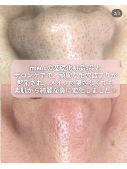 ミュー 岡崎店(mieux)/お悩みNo.1！毛穴の黒ずみ対策