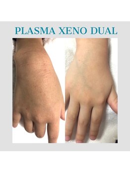 ビーダブリュー(BW...)/☆プラズマゼノデュアル施術例☆