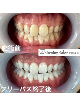 ホワイトニングサロン 京都烏丸店/ホワイトニング施術例
