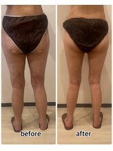 インディバジェム(GEM)/ビフォーアフター