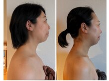 ビュート/小顔矯正３回で肩回りもスッキリ