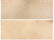 グレイス 久留米店(GRACE)/背中光脱毛