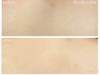 グレイス 久留米店(GRACE)/背中光脱毛